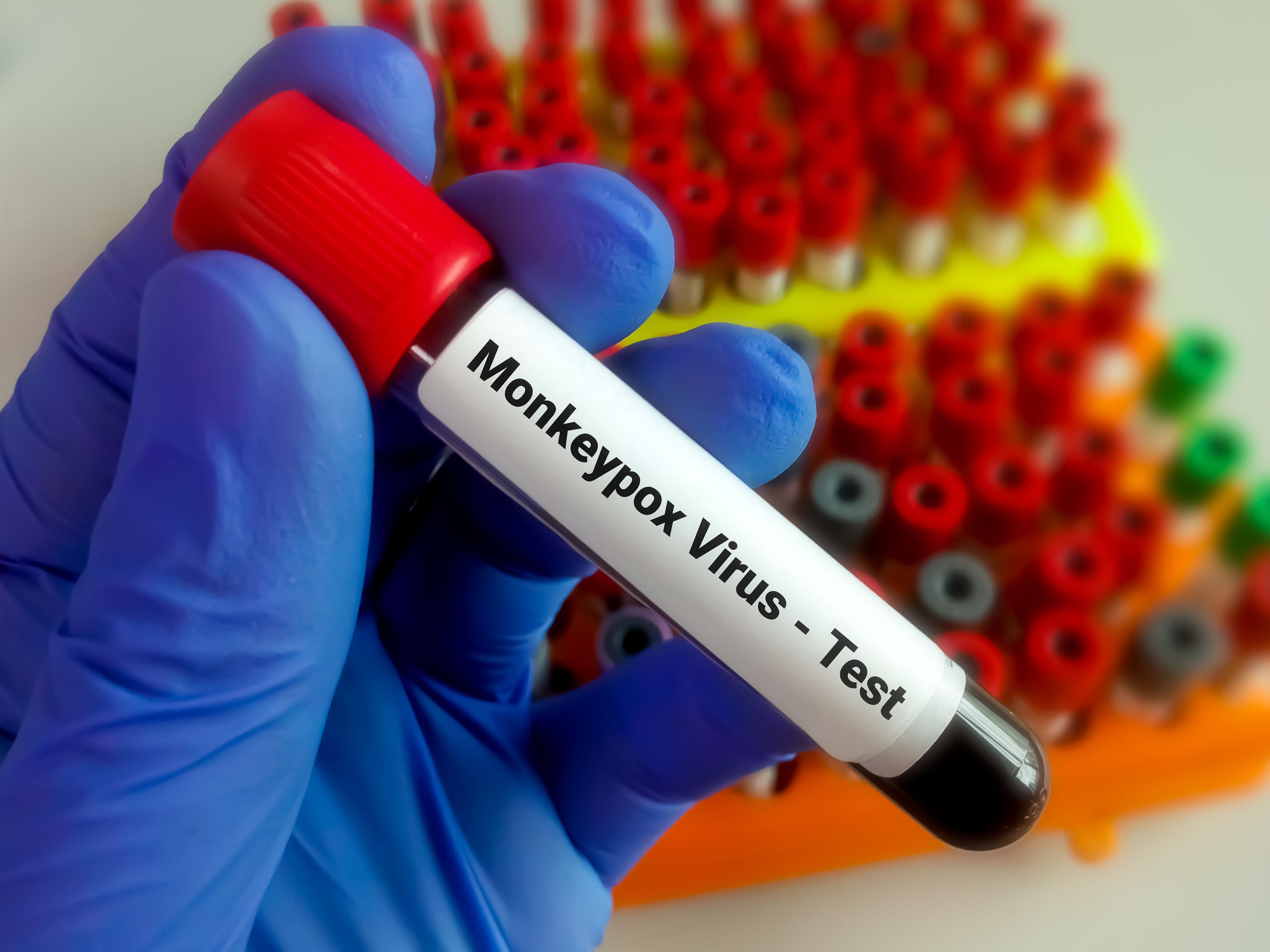 Who Approves World's First Mpox Test