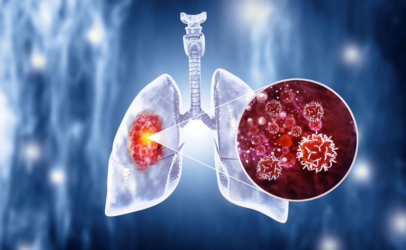 Lung Cancer Vaccination Trial Starts